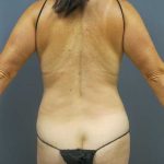 Liposuction Female Before & After Patient #7737