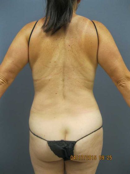 Liposuction Female Before & After Patient #7737