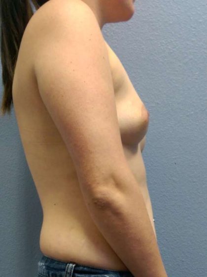 Breast Augmentation Before & After Patient #6435