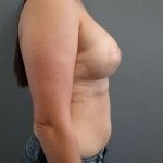 Breast Augmentation Before & After Patient #6435