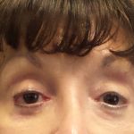 Filler Before & After Patient #7629