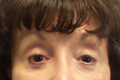 Filler Before & After Patient #7629
