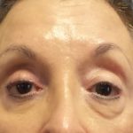 Filler Before & After Patient #7629