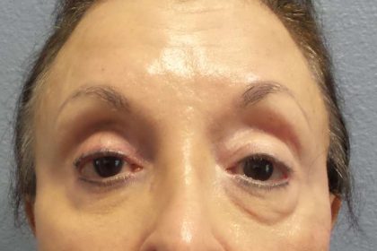 Filler Before & After Patient #7629