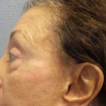 Filler Before & After Patient #7629