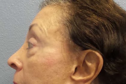 Filler Before & After Patient #7629