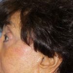 Filler Before & After Patient #7629