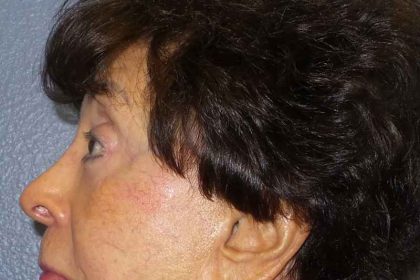 Filler Before & After Patient #7629