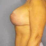 Breast Lift with Implant (Augmentation Mastopexy) Before & After Patient #4558