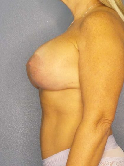 Breast Lift with Implant (Augmentation Mastopexy) Before & After Patient #4558
