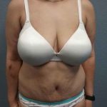 Abdominoplasty Before & After Patient #3455