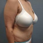 Abdominoplasty Before & After Patient #3455