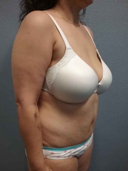 Abdominoplasty Before & After Patient #3455