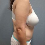 Abdominoplasty Before & After Patient #3455
