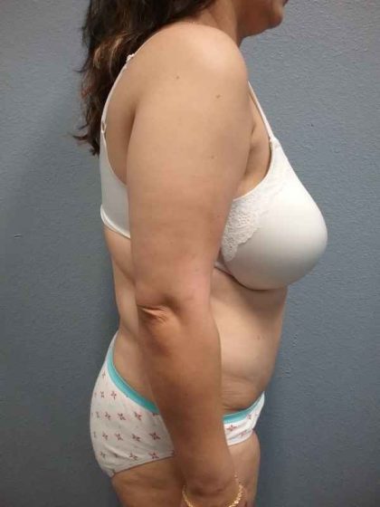 Abdominoplasty Before & After Patient #3455