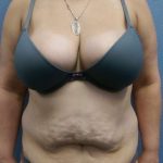 Abdominoplasty Before & After Patient #3455