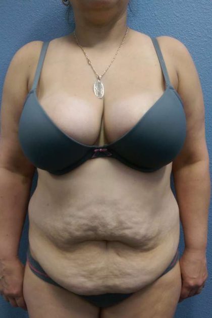 Abdominoplasty Before & After Patient #3455