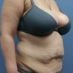 Abdominoplasty Before & After Patient #3455