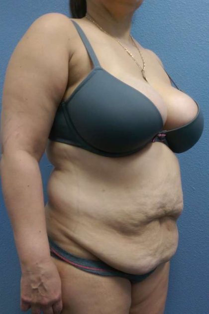 Abdominoplasty Before & After Patient #3455