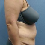Abdominoplasty Before & After Patient #3455