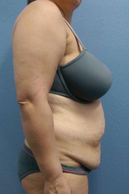 Abdominoplasty Before & After Patient #3455