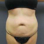 Liposuction Female Before & After Patient #8018