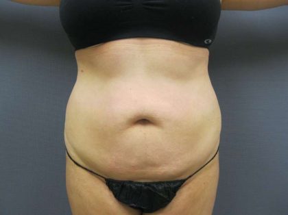 Liposuction Female Before & After Patient #8018