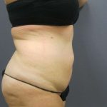 Liposuction Female Before & After Patient #8018