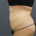 Liposuction Female Before & After Patient #8018