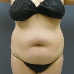Liposuction Female Before & After Patient #8018