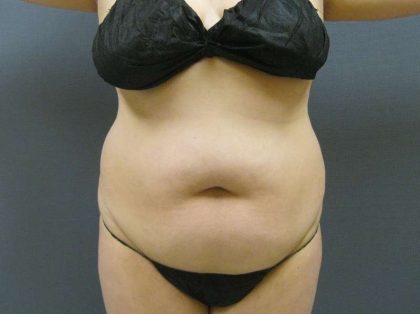 Liposuction Female Before & After Patient #8018