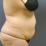Liposuction Female Before & After Patient #8018