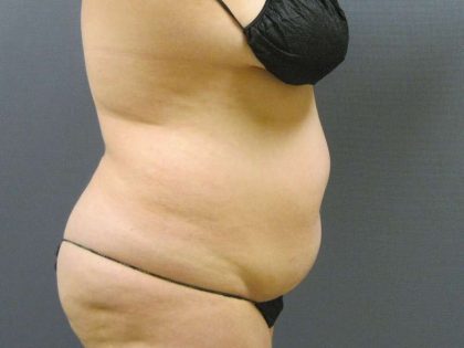 Liposuction Female Before & After Patient #8018