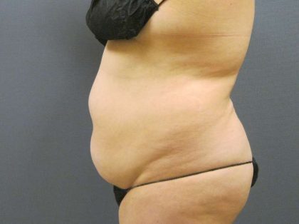 Liposuction Female Before & After Patient #8018