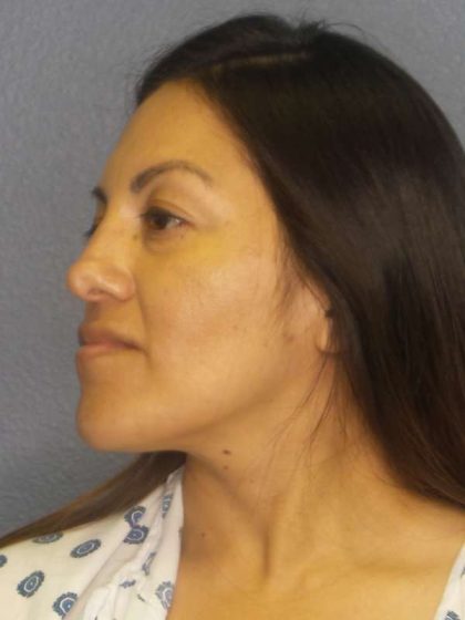 Rhinoplasty Before & After Patient #9848
