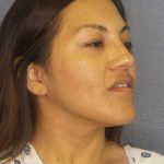 Rhinoplasty Before & After Patient #9848