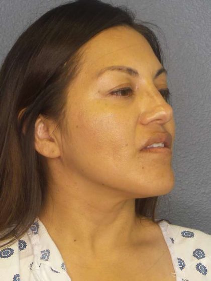 Rhinoplasty Before & After Patient #9848