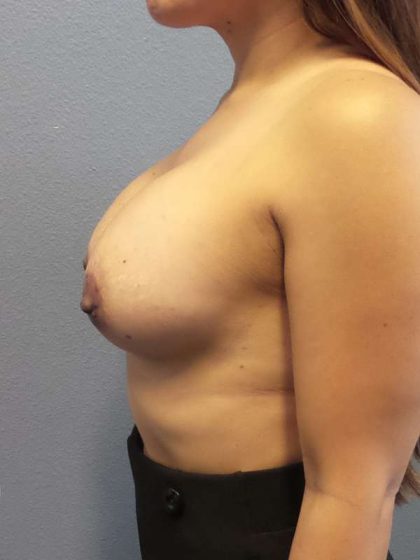 Breast Augmentation Before & After Patient #5898
