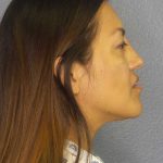 Rhinoplasty Before & After Patient #9848