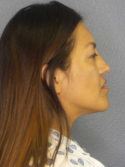 Rhinoplasty Before & After Patient #9848