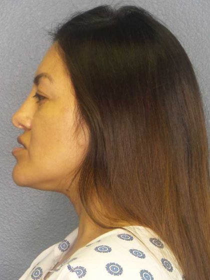 Rhinoplasty Before & After Patient #9848