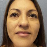 Rhinoplasty Before & After Patient #9848