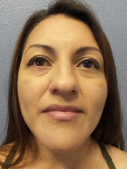 Rhinoplasty Before & After Patient #9848