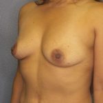 Breast Augmentation Before & After Patient #5898