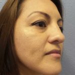 Rhinoplasty Before & After Patient #9848