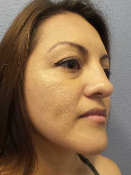 Rhinoplasty Before & After Patient #9848