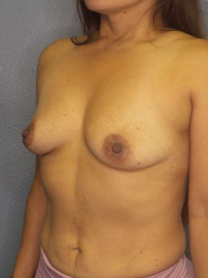 Breast Augmentation Before & After Patient #5898