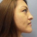 Rhinoplasty Before & After Patient #9848