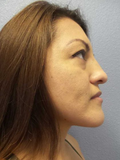 Rhinoplasty Before & After Patient #9848