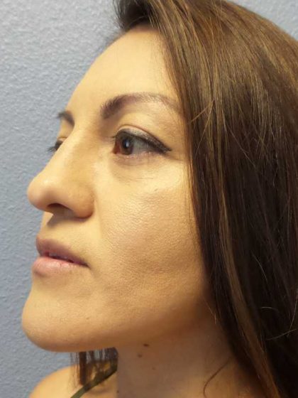 Rhinoplasty Before & After Patient #9848